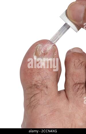 Hand Anwendung antimykotischen Lack auf einen großen Zeh Nagel mit Zehenpilz betroffen. Stockfoto