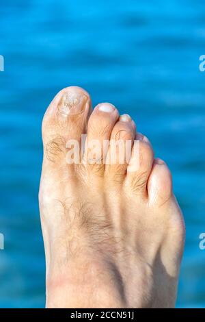 Füße mit einem Zehennagel mit Zehenpilz über einem befallen Strand Hintergrund Stockfoto
