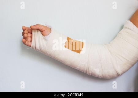 Zerbrochener Arm eines kleinen Mädchens, in Darsteller Stockfoto