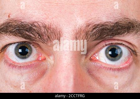 Große Augen des Mannes mit heller Haut und starker Augenbraue Und Kreise unter den Augen Stockfoto