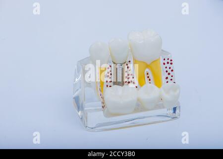Zahnprothese, Prothesen. Zahnarzthände während der Arbeit an der Prothese auf weißem Tisch Stockfoto
