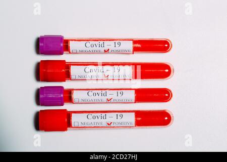Positive Bluttests für Coronavirus in Reagenzgläsern. Stockfoto