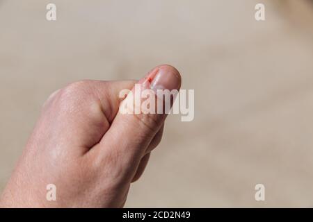 Daumentrauma. Blutung aus einem geschnittenen Finger. Blut von einem Finger. Stockfoto