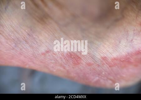 Fußpilz, medizinisch als Tinea pedis bekannt, ist eine häufige Hautinfektion der Füße, die durch Pilze verursacht wird. Stockfoto