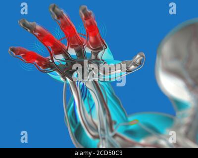 Arthritis in den Fingern oder in der Hand. 3D-Darstellung der Anatomie. Stockfoto