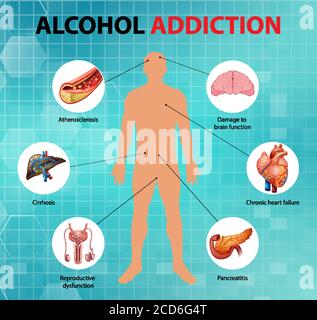 Informationen zur Alkoholabhängigkeit oder Alkoholismus Infografik Illustration Stock Vektor