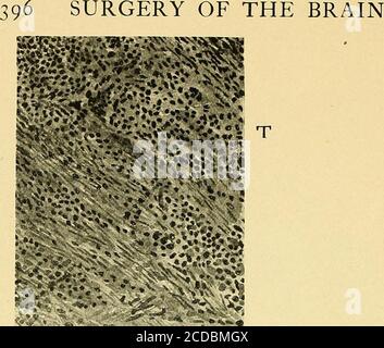 . Einige Punkte in der Operation des Gehirns und seiner Membranen . *^«SAFO„-« n Abb. 205. – mikroskopischer Abschnitt des Tumors, wo adhärent zu Dura. ( x 45.)T, Tumor; D, Dura.. Stockfoto