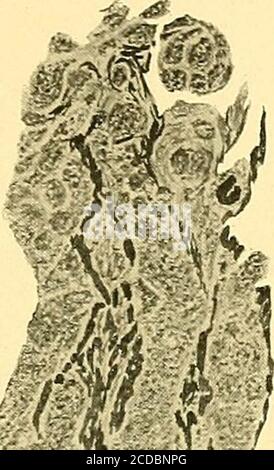 . Einige Punkte in der Operation des Gehirns und seiner Membranen . Abb. 200. – Teil des Tumors in der Nähe der Basis eines der gräulichen Prozesse, die sich zwischen dem Gehirn und dem frontalen Knochen (x 175). Beachten Sie die Tendenz zur konzentrischen Anordnung der Zellen, um Whorlen zu bilden. DES TUMORS DES GEHIRNS 389. Stockfoto