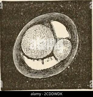 . Die pathologische Anatomie des Ohres . Abb. 28. Exostosen an der hinteren Wand des Jleatus in der Nähe der Trommelmembran. Abb. 29. Exostosen des Meatus. Bei der Bildung von Granulationen kann es zu einer sehr rappidigen Perforation der Trommelmembran und zur Suppranierung des Tympanums kommen. Exostosen sind bei Männern viel häufiger; besonders häufig, so Welcher, bei den Schädeln von transmarinen Rassen. Toynbee betrachtete Rheumatismus und Arthritis als ihre Ursachen: Ich habe sie häufig erblich gesehen und nicht mit den Krankheiten assoziiert. Syphilis ist sicher Stockfoto