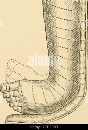 . Die chirurgische Behandlung der häufigsten Missbildungen von Kindern . Fuß muss gewaltsam umgekippt und verlängert werden, um die Ferse so weit wie möglich nach unten zu bringen, und während in der Stellung ein Assistent sollte die Putzrollen um den Fuß und Bein auftragen. Ein Narkosemittel wird bei dieser Anwendung sehr nützlich sein. Die Pflasterase sollte für zwei oder dreieweeks getragen werden, und dann wieder angewendet werden, und diese Behandlung kann so lange fortgesetzt werden, wie es offensichtlich eine deutliche Verbesserung, eine Periode, die möglicherweise unten als auf dem Durchschnitt zwei oder drei Monate. Die Verwendung von flexiblen Schienen, Stockfoto
