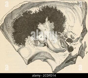 . Die pathologische Anatomie des Ohres . s des primären Epithelkrebses des Temporalbones, von dem zwei berichtet worden sind, und in allen von ihnen der Ursprung des Wachstums war die tympanische mu-cous Membran.^ Abb. 9 zeigt das Ausmaß der Zerstörung des Knochens in einem dieser Fälle, von innen gesehen. Eine Liste aller mir bekannten bösartigen Tumoren ist beschränkt auf fünf von Toynbee ^ (Karzinom) beschriebene Fälle, einen von Gerliard ^ (Karzinom des linken Petroknochens), einen von Billroth* (ohne Autopsie), zwei von Wilde ^ (Osteosarkom), einen von Travers^ (ohne 1 Archiv f. Ohrenheilkunde, ix.. S. 208, Stockfoto