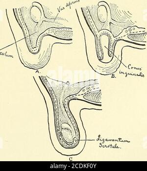 . Chirurgie, ihre Prinzipien und Praxis . TV Abb. Defer- 308.- Semixalbläschen und VasaENTiA, Posterior View (.Testut).1, Blase; 2, Prostata; 3, 3, Samenbläschen;4, 4, vasa deferentia; 5, Samengänge; 6, 6, Uretere; 7, perivesikuläre Cul-de-SAC des Peritoneums; 8, interdeferentielle Dreieck, nur in der properitonalen Beziehung getrennt von der properitonalen. Die beiden Kreuze (+ -i-) zeigen die Punkte an, an denen die Harnleiter in der Blasenwand abtauchen. Um zum Kind zu werden, der Hoden ^-^. Abb. 309. – Herabstieg des Hodens in drei Stufen.Th Stockfoto