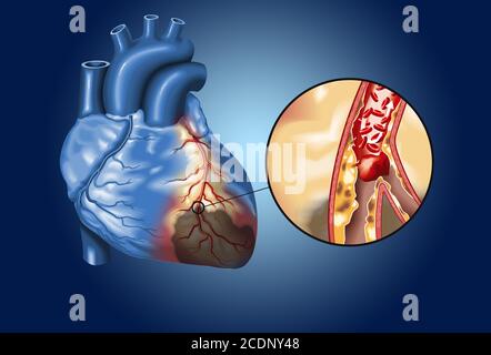 Plaque in der Koronararterie, Blutgerinnsel (Thrombus), die abbricht und den Blutfluss blockiert (Herzinfarkt) Stockfoto