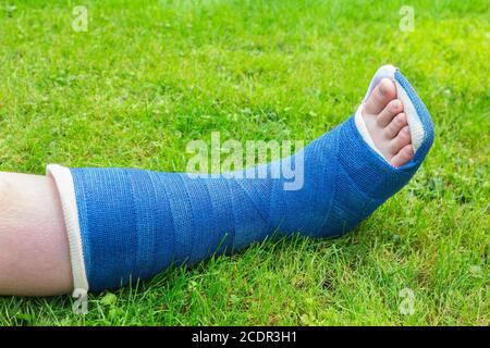 Ein Gipskleg Junge auf Gras Stockfoto