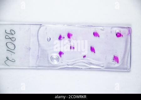 Schichten des Tumors unter Glas. Die histologische Untersuchung der tumorzellen Für die Anwesenheit von Krebs Stockfoto