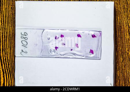 Schichten des Tumors unter Glas. Die histologische Untersuchung der tumorzellen Für die Anwesenheit von Krebs Stockfoto