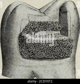 . Der Zahnkosmos . Kraft auf ein Zwanzigstel Millimeter von seiner korrekten Position. Die Theorie ist sehr einfach, aber die Technik ist sehr schwierig und kann nur nach langer und sorgfältiger Praxis erworben werden. Wir sehen daher, dass in der Manipulation des kohäsiven Goldes drei Dinge sind Abb. 14.. Von primärer Bedeutung, viz, die Wände von dicken Massen zu erreichen, akorrect Linie der Kraft zu erhalten, und den Stopfen richtig zu treten. Die Wände, die von den dicken Massen des Goldes und des Goldes angegangen werden, die gegen sie flowed und durch die Linie der Kraft und des genauen Steppens eingekeilt werden, ist das elasticdentin des Zahnes Stockfoto