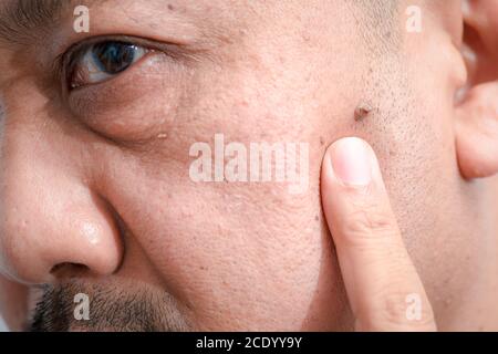 Geschlossen von großen Haut-Tags oder Acrochordon auf Gesicht mittleren Alters asiatischen Mann, Health Care Konzept Stockfoto