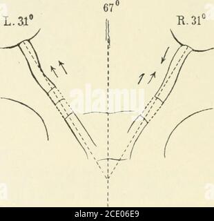 . Beiträge zur Anatomie der Orbita . die Obliqui in der Ruhelage angeschrieben, so wird der hintere Bulbusabschnitt etwas nach oben-innen gezogen. Gleichzeitigen wird in gleichem Sinn die Einführungsstelle des Sehnerven mitbewegt. Werden nach innen-unten gerollt, so wird der SE/inervech nicht etwa ganz gestreckt. Wird sodann der obliquus apprespond,so wird der hintere Bulbusabschnitt nach oben-innen gezogen,der Sehnerv dabei nicht gezerrt. - die Papille erscheint an dem hin-teren Abschnitt des linken Auges ?iahezu rund. *) bei den Sektionen wurde die Orbita mit ein Stockfoto