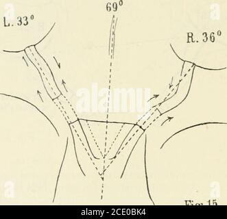 . Beiträge zur Anatomie der Orbita . Verwachsstelle FI?-. 14. Ablauf der Sehnerven. R.: Erst läuft er ein wenig nach unten, dann macht er eine härtere Biegung nach aussen-oben, schließlichgeht er fast horizontal ziemlich gerade herüber zum Bulbus. L.: DerSehnerv läuft erst ein klein wenig nach unten, macht dann einenflachen Bogen nach oben-innen und zieht schließlich horizontal nachaussen zum Bulbus. Wird der Bulbus nach innen-unten rotiert, so wird hier keine Zerkerung an der Einführungsstelle des Sehnerven durchgeführt. Die Papille erscheint normal. 70 15. Fall.* R., Ilerriiiann, 40 J. Stockfoto