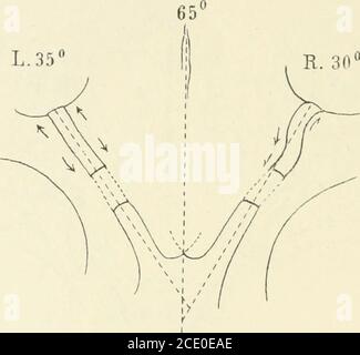 . Beiträge zur Anatomie der Orbita . Ablauf der Sehnerven beiderseites ähnlich. Im Grossen und Ganzennahezu horizontal. Nach Australien aus dem Can. Opt. Stärkere Biegungnach innen-unten, dann nach aussen und etwas nach oben zum Bulbus. Canal. Opt. Ziemlich in gleicher Höhe mit Insertion am Bulbus. Werden die bulbi nach innen-unten rotiert, so werden die sehnerven knapp gestreckt. An dem e.xcidierten hinteren Bulbusabschnittschein gegen das Licht halten die Papille kreisrund. R. Bulbus Achsenlänge c. 22,5. Zu Lebzeiten wurde ophthalmoskopisch die Refraktion bestimmt.R.-A.: Refraktion schwa Stockfoto