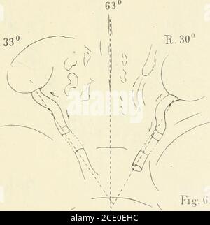 . Beiträge zur Anatomie der Orbita . angeschrieben, so wird der hintere Bulbusabschnitt etwasnach oben-innen gerollt, wobei die Eintragsstelle des Sehnerven etwasmitbewegt wird. Wird, nachdem der Bulbus nach unten-innen rotierword, der obliquus angeschrieben, so wird die Einführungsstelle noch weiter ein wenig gehoben. The sehne of 01)li(iuus liegt dem Bul-Bus eine grössere Strecke auf. - an excidierten linken hinterenBulbusabschnitt erscheint die Papille vollständig rund. Im Augenhinter-grund mehrere Chorioidealtuberkel, 6i 6. F A 11. * concerning ^ and SVA mm. Gross (eared somit to Group Stockfoto