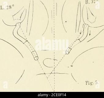 . Beiträge zur Anatomie der Orbita . unten, links ausser der Biegung nach unten auch noch Biegung nach aussen. Im can. Opt. Horizontal nach aussen und vorn; dannstark nach unten und weniger stark nach aussen, zuletzt wieder etwasansteigend zum Bulbus. Kanal. Opt. höher als Insertionsstelle am Bulbus. Werden die bulbi nach innen-unten rotiert, so werden die sehnerven noch nicht einmal ganz gestreckt. Die Papille erscheint an demexcidierten hinteren Bulbusabschnitt nahezu kreisrund. Die bulbi sindklein, 6o 5. Fall.* *) in den mit einem Stern versehenen Fällen war das Abfüllungsstück auf der eine Stockfoto