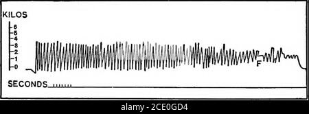 . Dynamische Faktoren in der Bildung . LlnfL- Abb. 7. – Ergografische Tracings zeigen, (i) in freiwilliger Anstrengung, (2) in elektrialer Stimulation des Nervs, (3) in elektrischer Stimulation des Muskels, (Scrip-ture.l nach Mosso.) Die relativen Höhen der Tracings stellen die in den verschiedenen Formen der Stimulation aufgewendeten therelativen Mengen an Energie dar.Es ist zu sehen, daß in freiwilliger Bemühung das Subjekt allmählich die Kraft der Anstrengung verliert und bald keine Kraft mehr ausüben kann; Aber wenn an diesem Punkt ein Nerv, der zu dem Muskel, der tätig war (in diesem Fall der Mittelfinger ausgeübt wurde) aufgeregt werden Stockfoto