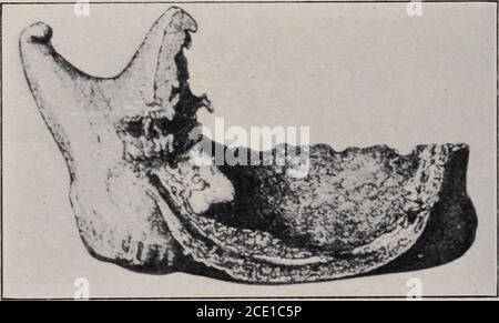 . Journal of the New York Institute of Stomatology, American Academy of Dental Science, Harvard odontological Society und der Metropolitan District (Mas . hroot; aber gelegentlich wachsen sie in kurzer Entfernung von der Zahnwurzel. Sie sind in der Regel klein. Die Wand ist faserig, mit einer Auskleidung von Plattenepithel; der Inhalt Flüssigkeit. In der Regel, ein entzündlichen Prozess, der die peridentale membraneantedades die Zyste. Diese ätiologische Beziehung scheint die Stimulation der oben beschriebenen Trümmer durch die Nähe des entzündlichen Prozesses zu dependupon. Wenn eine apikale Pericementitis fol-lowi Stockfoto