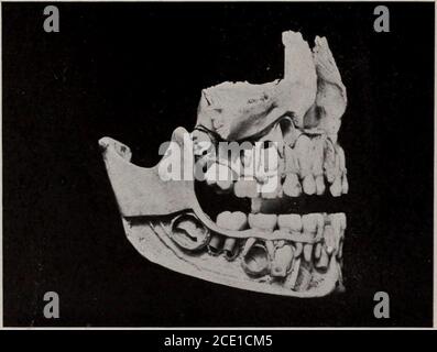 . Zeitschrift des New York Institute of Stomatology, American Academy of Dental Science, Harvard odontological Society und des Metropolitan District (Mas . n die chaotischen de-scriptions von Krippen Federn, Platten und Wagenheber-Schrauben, Das wird es ihm möglich machen, wissenschaftliche Diskriminierung auf den vorliegenden Fall anzuwenden, die Ätiologie, den Behandlungsplan und die Prognose zu determinieren. 156 DAS JOURNAL. Vererbung und Entartung werden fest auf seinen Verstand eingeprägt sein, die Vererbung von Rassen verschiedener Arten, um die Verformungen zu produzieren, das Erbe der Zähne des Vaters und der Kiefer der Mutter, Stockfoto