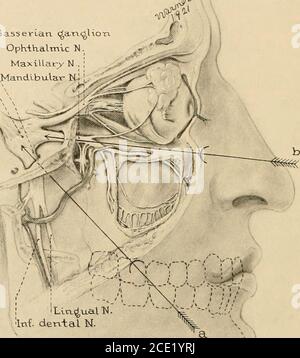 . Regionalanästhesie : seine technische und klinische Anwendung . amen ovale ist in den meisten Fällen durch den dritten Zweig in sucha Weise gefüllt, dass, um die Gasserian Ganglion zu erreichen, die Nadel unausweichlich trifft den Nerv am Eingang des Kanals und induziert paresthesiasin seinem Gebiet. Die Situation des Foramen ovale, an der Basis des Pterygoidprozesses, variiert mit dem Schädel; aber das wichtigste Wahrzeichen ist die glatte infratemporale Ebene, die vor dem Foramen anterior ist und mit welcher die Nadel in Kontakt kommen muss, bevor sie das Foramen ovale erreicht. Drei oberflächliche Orientierungspunkte werden normalerweise genommen, s Stockfoto