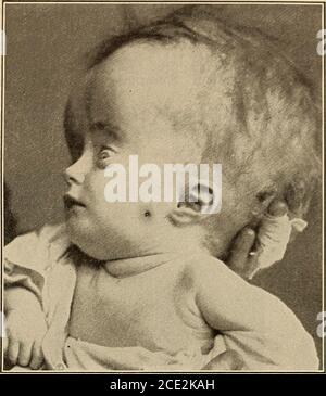 . Krankheiten der Kindheit und Kindheit . schwer zu bestimmen. In einigen Fällen wurde Syphilis als ursächlicher Faktor angegeben. Ein Interessantes Papier wurde von DAstros/WHO erschienen beschreibt 12 Fälle, in denen Hydrocephalus • syphi-litischen Läsionen assoziiert war, so dass der Zustand w^als angeborene. Von einigen wird angenommen, dass chronischer hy-Drocephalus auf Tuberkulose zurückzuführen ist. Pathologie. – die Veränderungen im Gehirn resultieren aus der allmählichen Akku-mulation von Flüssigkeit in den Ventrikeln. Das Septum lucidum ist in der Regel brokendown, und alle Wege der Kommunikation zwischen den ventrikulären Kav-ities sind stark e Stockfoto