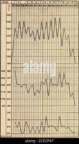 . Erkrankungen des Säuglings und der Kindheit . Hören ist eine der häufigsten Folgeerkrankungen dieser Krankheit. Chronische Nephritis und Endokarditis, mit der Folge einer dauerhaften Läsion der Mitralklappen, folgen häufig Scharlach. Gangrän von Ar^ns und Beinen nach Scharlachfieber und anderen Infektionskrankheiten. - Eichhorst- berichtet über den Fall eines 4-jährigen Mädchens, das einen ungewöhnlich starken Angriff von Scharlachfieber hatte. Am Ende der dritten Woche traten Zeichen der Embolie der A. poplitea sttddenly im linken Fuß und Bein auf. Gangrän ging weiter, bis die Demarkationslinie oberhalb der lowe scharf exhibiert wurde Stockfoto