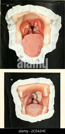 . Erkrankungen des Mundes; für Ärzte, Zahnärzte, medizinische und zahnärztliche Studenten. E sollenund die Follikel wurden mit eiterhaltigen Plugs gefüllt, begleitet von Fieber und Schluckbeschwerden. Der leicht zu sehende graue schleimhautähnliche Rand der yphilitischen Angina hielt nach der Heilung der Angina follicu-laris an. Abbildung 40. – Diphtherie Es gibt eine aktive Entzündung. Die Mandeln sind leicht geschwollen. Eine grau-weiße, markant ad-herent Membran liegt auf den linken vorderen und poz-terior Säulen der fauces, links tonsil, links Hälfte des weichen Gaumen und Uvula, und erstreckt sich bis zur posteriorpha Stockfoto