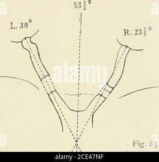 . Beiträge zur Anatomie der Orbita . h oben und etwas nach aussen, dann nach aussen schnell horizontalherüber zum Bulbus. Canal. Optici tiefer als Optikusinsertion am Bulbus. Wird der Bulbus nach innen-unten rotiert, starke Zerrung an derInsertionsstelle. Sklera im hinteren Abschnitt um die Einleitungsstelle desOptikus herum blulich durchscheinen; exquisiter Langbau. Aeusserer Sagittaldurchmesser = ca. 27 – 28 Mm. Der Bruder, den ich zum öftern genau untersuchen konnte, ist gleichfalls höchstgradient kurzsichtig. Mit konkav 24 Dio])tr. beste Kor-Rektion bei stark abgesetzter Sehstärke. Ophthalmosk Stockfoto