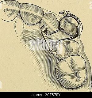 . Kieferorthopädie, oder Fehlstellung der menschlichen Zähne; seine Prävention und Abhilfe . 148 KIEFERORTHOPÄDIE. Draht lang genug, um auf den palatinalen Oberflächen der beiden Zähne an der Grenze des Raumes, um von derecuspid besetzt werden ruhen. An ihren äußeren Extremitäten wurden diese Metallbänder mit einem gebogenen Bolzen und einer Mutter überliegender Abb. 90. Abb. 91. Stockfoto