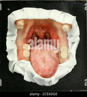 . Erkrankungen des Mundes; für Ärzte, Zahnärzte, medizinische und zahnärztliche Studenten . PLATTE XII Abb. 15. – Angina Sypliilitica (SyphiliticAngina) Abbildung 15. – Angina Sypliilitica (SyphiliticAngina) in diesem Fall ist auf der geröteten, ödematösen und geschwollenen Schleimhaut des isth-mus der Gauces zu sehen, weicher Gaumen, Und Uvula, eine Reihe von leuchtend weichen grauen, bogenförmigen oder runden Schleimhäuten, die etwas aussehen, als ob Milch auf die Oberfläche der Schleimhaut gegossen worden wäre. Dies ist eine milde Form von syphilitischer Angina, und wenn untersucht ein ungünstiges Licht könnte für asimple catarrh verwechselt werden Stockfoto