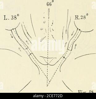 . Beiträge zur Anatomie der Orbita . Abb.-. 47. Ablauf der Sehnerven. R. : Nahezu horizontal, erst ein klein wenig nach innen-unten, dann etwas aufsteigend und ein wenig nachaussen zum Bulbus. L.: Zuerst etwas aufsteigen nach aussen, schnell horizontal gerade nach vorn. Etwas nach innen zum Bulbus. Canal. Opticus liegt links etwas tiefer als Insertion am Bulbus,rechts ziemlich in gleicher Höhe. Bei Bewegung nach innen-unten werden die Sehnerven abgemahnt, (rechts mehr) aber nicht gezerrt. Side Sehnerven bläulich (Blutung in dem Zwischenscheiden-Raum). Schusskanal hinter der Orbita. Stockfoto