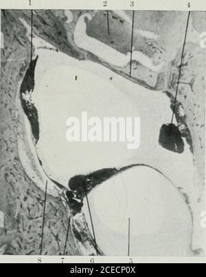 . The Journal of Laryngology and otology. Abb. 9. – horizontaler Schnitt durch das rechte Ohr des presentcase (x 20 Durchm.). (1) Blutung im perilym-phatischen Raum des Vestibulums in der Nähe des utrikulären Verzweiges des vestibulären Nervs; (21 Gesichtsnerv; :i, crista des äußeren Kanals; H, Hohlraum des Utriculus, der ein Luftglockenartefakt enthält; (5) Neuroepithel ofutricle ; (6^ Hohlraum des Sakkulums.. Abb. 10.- Horizontale Schnitt durch-h riyhf Ohr des vorliegenden Falls (x 20 diam.i. il) Ha?morrhage inperilymphatische Raum des Vestibulums externe tosaccule ; i2, Eiter in Nische des ovalen Fensters ; a) Fußplatte von Stapeln ; (-i) Hämor Stockfoto
