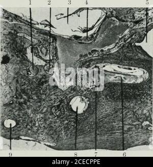 . Das Journal of Laryngology and otology. Loj utricle;(11) glatte Ende des äußeren Kanals; (12) crus commune. Abb. 2. - Horizontale Schnitt durch das linke Ohr des presentcase, etwa auf der gleichen Ebene wie Abb. 1x3 diam.i.1) äußerer Meatus mit desquamiertem Epithe-Lium; i2) Incus; 3) Malleus; (i, Gesichtsnerv; (oi tubal-Teil der Tympanhöhle – der latterenthält Eiter; f6j basale Cochlea-Spule; (7 internalmeatus; (8) gebrochener Sakkulus : 9) Utriculus ;(10) und 11 (12) horizontaler Crus. 1 2 3 4 5 6 7 ^ YGL fe. 1^ i-^ ^^^j r ?--- .y ,<^F^3^ •?^M H h 1 .- - ^ ^ ^ 1 w ^7^ 11 10 Abb. 3. – Horizont Stockfoto