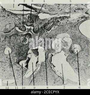 . The Journal of Laryngology and otology. Abb. 1. - Horizontale Schnitt durch normales linkes Ohr des Säuglings, in Resriou des ovalen Fensters < x 3 Durchm.) (1) Facialnerv ; (2) Lon^ Prozess des Incus ; (3) Kopf der Stapes ; (4) Griff der Malleus an der Tympanik-Mem-Brane befestigt ; (5, Eustachian Rohr (tubal Teil der Tym-Panic cavityj; (6) scala tympani der basalen cochlearcoil ; (7) interne auditorische meatus mit achten Nerv ; (8); (Loj utricle;(11) glattes Ende des äußeren Kanals; (12) crus commune. Abb. 2. - Horizontale Schnitt durch das linke Ohr des presentcase, etwa auf der gleichen Ebene wie Stockfoto