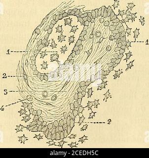 . Manuel d'histologie experimentale. Abb. 71. – Coupe dune exostose sous-inguéale du gros orteil. - o, ongle ;c, épidermoet Corps muqueuxde Malperighi; p, papilles hypertrophiées du derme; n, n, trabdcules osseuses; s, tissu embryonnaire. – Grossissement de 25 diamètres. Atteints surtout dans leurs extrémités épiphysiaires. Il ne faut pas. Abb. 72. – Partie ossifiée de la tumeur représentée eu n dans la ligure precéaente. - 1, trabéculcsosseuses et corpuscules osseux ; 2, cellules médulaires disposées le long des trabdcules osseuses : onvoit plusieurs de ces cellules en train de devenir des cellu Stockfoto