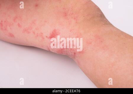 Hautausschlag auf das Bein eines Kindes isoliert auf weißem Hintergrund, Rötung, allergische Reaktion, Dermatitis Symptom. Stockfoto