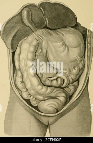 . Über retro-peritoneale Hernie : seiend die 'Arris und Gale' Vorlesungen über die 'Anatomie und Chirurgie der peritonealen Fossae' : an der Royal College of Surgeons of England im Jahr 1897. Dünndarm und extremelydistended Dickdarm, mit dem processus vermiformis, wereencountered, von einer dünnen Peritonealmembran bedeckt (Feige. 40).beim Durchreißen der dünnen Membran trat der gestreute Großdarm nach vorne. Dieses hatte die Schwellung gebildet, die in der Kontur einem aufgeweideten Magen ähnelt. Einige leicht Adhäsionen zwischen dem Darm und dem investierenden Peritoneum wurden getrennt, und das ganze t Stockfoto