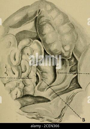 . Über retro-peritoneale Hernie : wobei die "Arris und Gale" Vorträge über die "die Anatomie und Chirurgie der peritonealen Fossae" : Geliefert am Royal College of Surgeons of England im Jahr 1897. Angesiedelt, aufgrund der Mangel an Beschreibung, insbesondere in Bezug auf die Beziehungen der Schiffe zum Hals der hernial Sack. Es ist zu hoffen, dass der Ursprung und die Häufigkeit der Hernie; kann definitiv durch die Veröffentlichung aller beobachteten Fälle, mit besonderem Bezug auf die genaue Beziehungen der Colica-Sinistra Arterie und der inferioren mesenteric veinto den Hals des Hernialsacks. Die foll Stockfoto