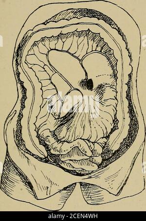 . Auf retro-peritonealer Hernie : seiend die 'Arris und Gale' Vorlesungen über die 'Anatomie und Chirurgie der peritonealen Fossae' : an der Royal College of Surgeons of England im Jahr 1897. Ein paar Fälle eine Teilung der Öffnung des Sacks durch aperitoneale Falte beobachtet worden ist. Dies ist wahrscheinlich in ähnlicher Weise wie die Teilung der oberen und unteren duodenalen Fossae. Brosike ist jedoch geneigt, dass eine solche Teilung ergibt sich aus der Erhöhung der aperitonealen Falte durch die inferiore mesenteric Vene, die die Mündung des Sacks kreuzt. Ich habe die Beschreibung von nie überprüft Stockfoto