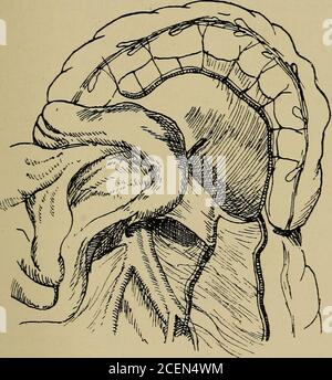 . Über retro-peritoneale Hernie : seiend die 'Arris und Gale' Vorlesungen über die 'Anatomie und Chirurgie der peritonealen Fossae' : an der Royal College of Surgeons of England im Jahr 1897. Durch die Aorta, die in die Höhle der Thefossa projiziert; und seitlich durch zwei seröse Falten - die duodcno-pavictalfolds. Diese sind dreieckig, haben eine Basis, die nach unten schaut, eine duodenale Grenze, die auf jeder Seite an der posterioren Oberfläche des Duodenums befestigt ist, und eine parietale Grenze, die mit dem posterioren parietalen Peritoneum auf jeder Seite der Aorta vermischt wird. An der Linie der Fusion des linken Rechtsaments die Stockfoto