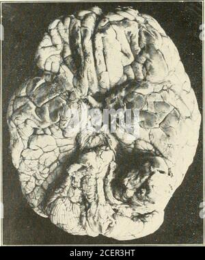 . Beiträge aus der Abteilung für Neurologie und dem Labor für Neuropathologie (Nachdrucke). Symptome haben viel größeren diag-nostischen Wert als das Auftreten der gleichen Symptome nach intrakraniellen Druck seit einiger Zeit erhöht worden. Niemand macht eine fokale Diagnose von Papilledema; höchstens verwendet er sie nur als Hinweis auf die Seite des Gehirns betroffen, aber NervenTaubheit auftritt mit anderen Anzeichen von Tumor wurde von fast allen als Offokalisierungs Wert angesehen. Wenn es sich spät im Symptom-Komplex entwickelt, gibt es eine Diosibilität, dass es nur ein Zeichen von intrakranialem Druck sein kann, und com Stockfoto