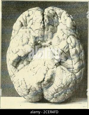 . Beiträge aus der Abteilung für Neurologie und dem Labor für Neuropathologie (Nachdrucke). E Face. Taktile Empfindung kann wegen des mentalen Zustandes nirgendwo getestet werden. Er untersteht teilweise, was zu ihm gesagt wird. Die Nackenmuskulatur ist deutlich steif. Die rechte obere Extremität scheint vollständig par-alysiert zu sein; das Einstechen mit einer Nadel in dieser Extremität verursacht eine gewisse Bewegung der linken oberen Extremität, aber keine der rechten oberen Extremität, unddie Einstechen ist nicht korrekt lokalisiert. Die rechte obere Limb scheint ein gestörtes Gefühl zu haben. Die Bizeps und Trizepsreflexe sind im linken oberen li etwa normal Stockfoto