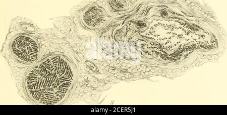 . Beiträge aus der Abteilung für Neurologie und dem Labor für Neuropathologie (Nachdrucke). 4 Rhein-Krankheit der Radikularnerven --^ HYSTERIE, WAS ES IST UND WAS ES NICHT ist.* von CHARLES K. MILLS, M. D., Professor für Neurologie an der Universität von Pennsylvania; Meurologisl an das Philadelphia General Hospital. {vom Detortnient of Neurology der University of Pennsylvania.) Hysterie, seit der Zeit des Vaters der Medizin ein beliebtes Thema bei medizinischen Schriftstellern, ist unter dem einschätzenden Einfluss von Babinski, der die Aufmerksamkeit der Neurologika auf sich gezogen hat, wieder an die Front gekommen Stockfoto